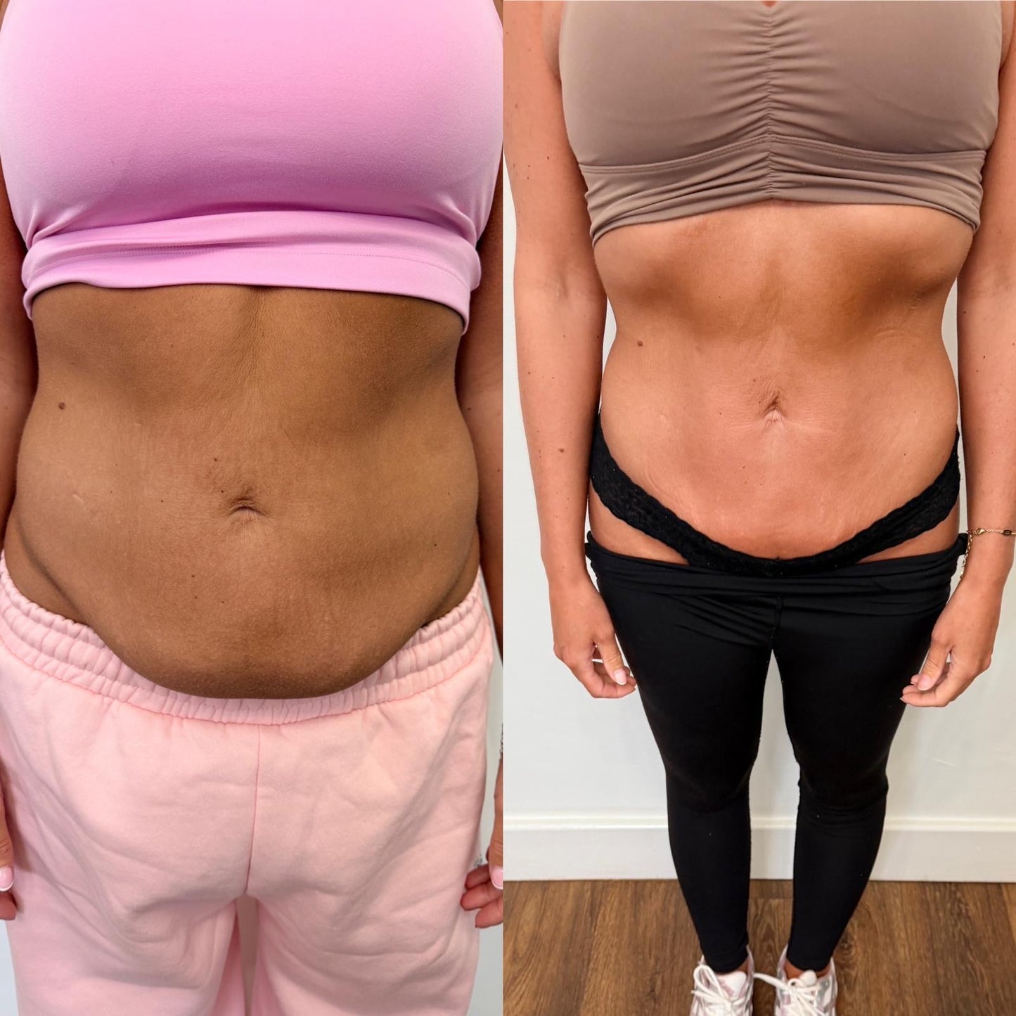 Body sculpting course - Two areas - 5 treatments