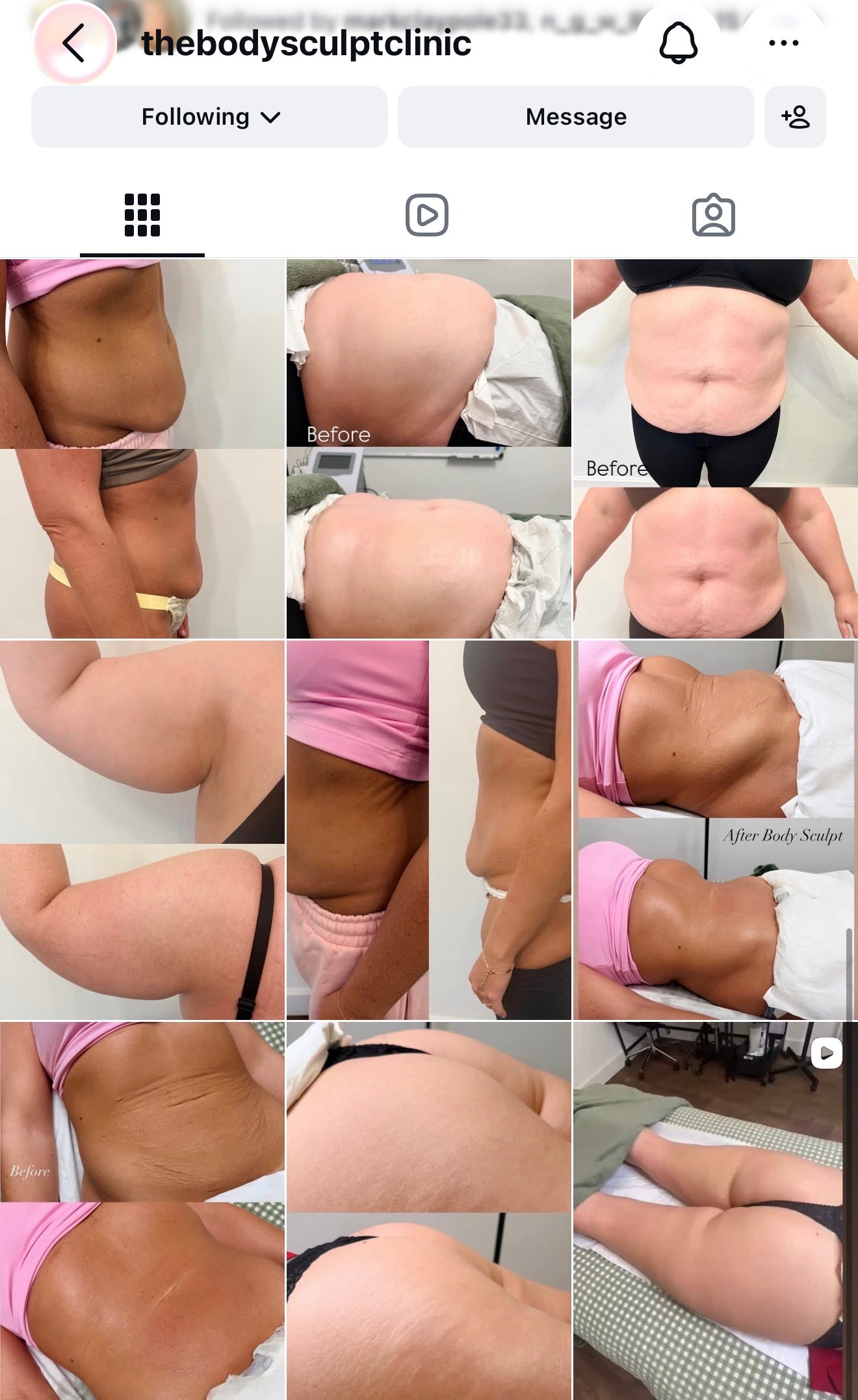 Body sculpting course - Two areas - 5 treatments